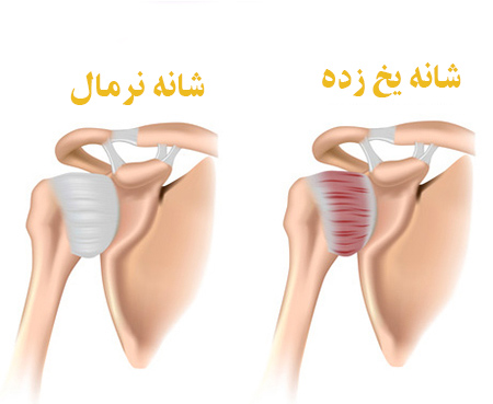 فرق شانه یخ زده با نزمال