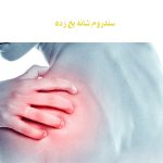 درمان سندروم شانه یخ زده
