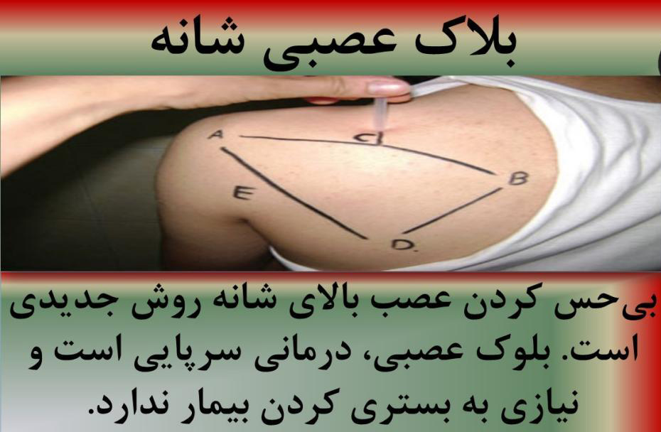 در مورد بلاک عصبی بیشتر بدانید