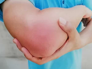 بد جوش خوردن استخوان