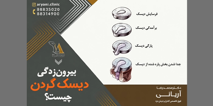 درمان دیسک گردن