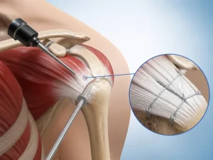 ترمیم تاندون شانه چگونه انجام میشود؟